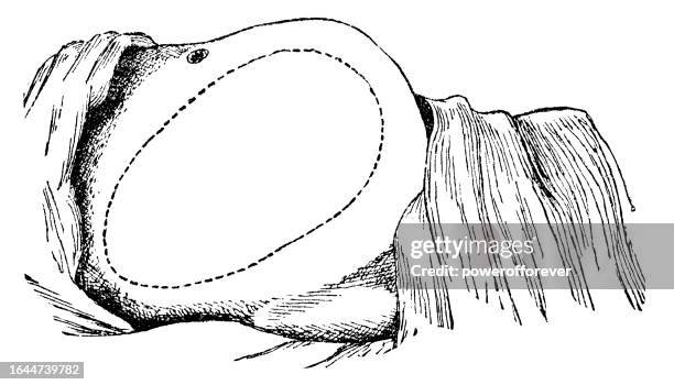 medical illustration of size and location of a large ovarian multilocular cystic tumor in a patient - 19th century - digestive system model stock illustrations