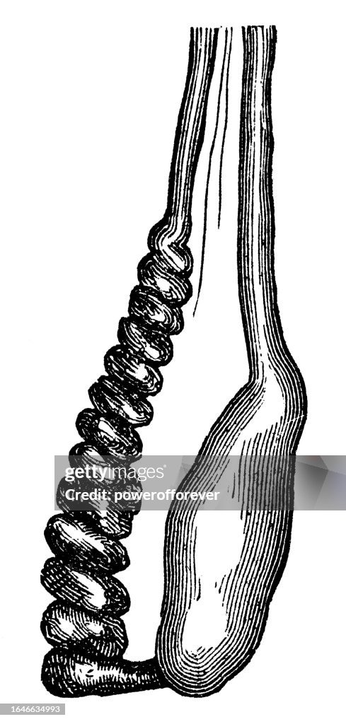 Medical Illustration of a Human Testicle with Atrophy - 19th Century
