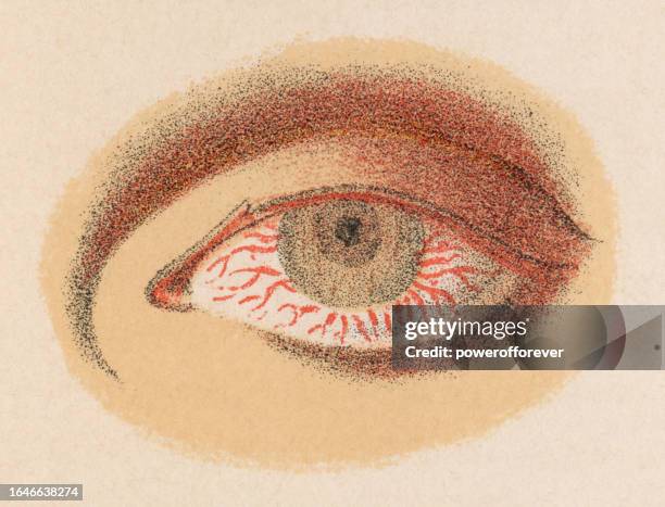 ilustraciones, imágenes clip art, dibujos animados e iconos de stock de ilustración médica de la uveítis en una persona con una infección sifilítica ocular - siglo 19 - ojos rojos