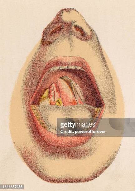 ilustraciones, imágenes clip art, dibujos animados e iconos de stock de ilustración médica de una úlcera paladar en la boca de una persona con sífilis congénita - siglo 19 - sifilis