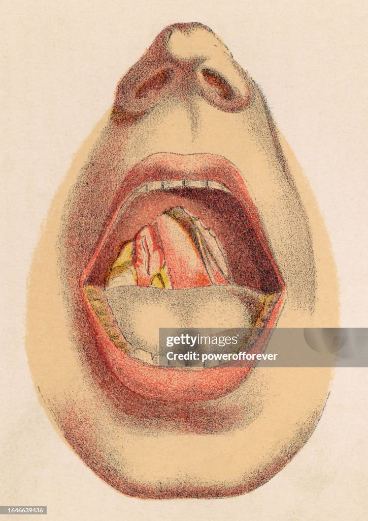 Medical Illustration of a Palate Ulcer in the Mouth of a Person with Congenital Syphilis - 19th Century