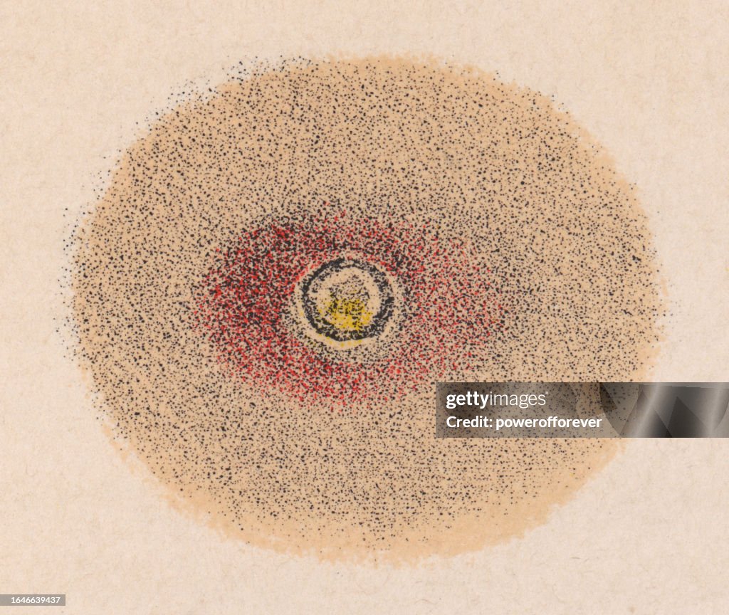 Medizinische Illustration der menschlichen Haut mit einem Chancre - 19. Jahrhundert