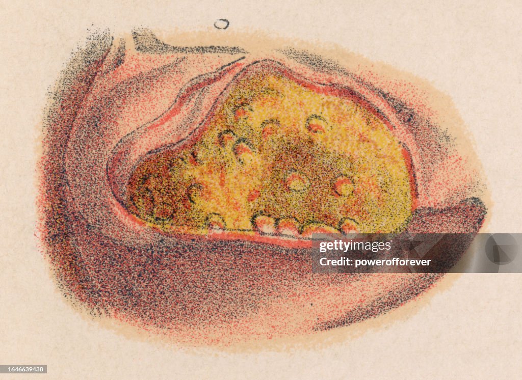 Medical Illustration of Human Skin with a Chancroid - 19th Century