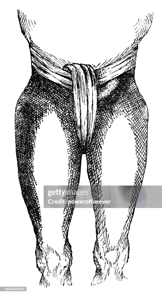 Medical Illustration of a Person with an Indirect Inguinal Hernia - 19th Century