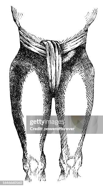 medical illustration of a person with an indirect inguinal hernia - 19th century - inguinal hernia stock illustrations