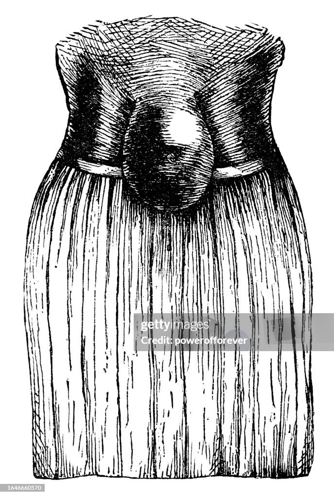 Medical Illustration of a Person with an Umbilical Hernia - 19th Century