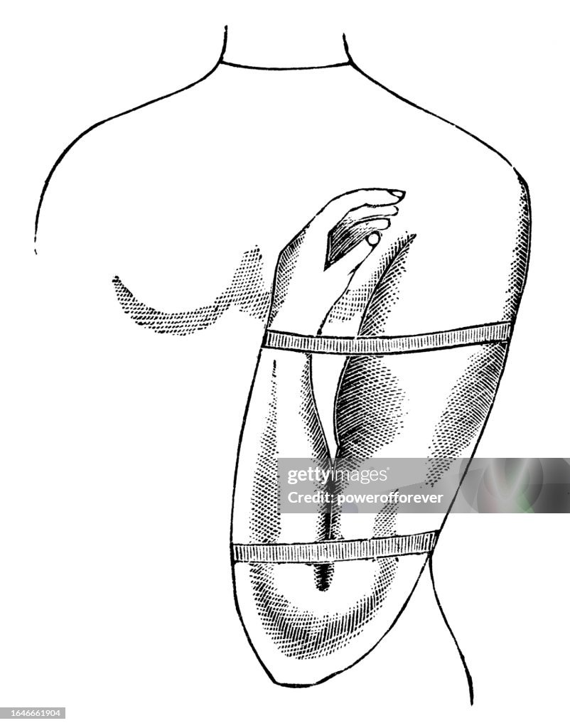 First Aid Illustration of a Human Arm with Flexion of the Joint to Stop Severe Bleeding - 19th Century
