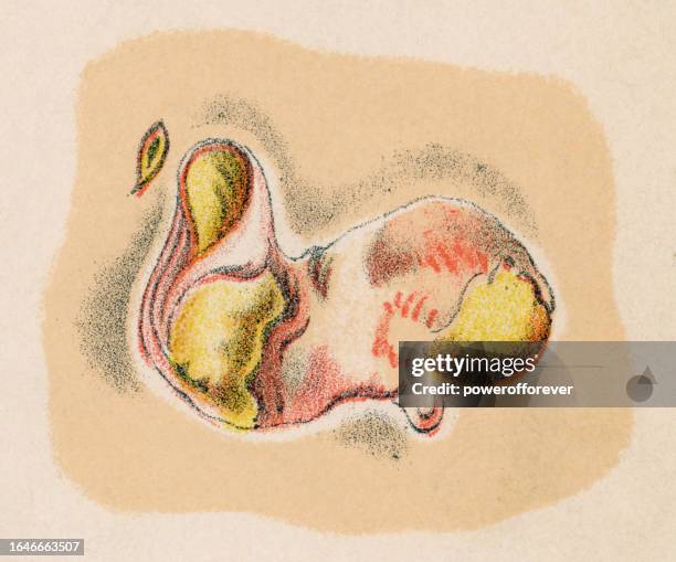 ilustrações de stock, clip art, desenhos animados e ícones de medical illustration of a gumma on the bone of a person with syphilis - 19th century - treponema pallidum