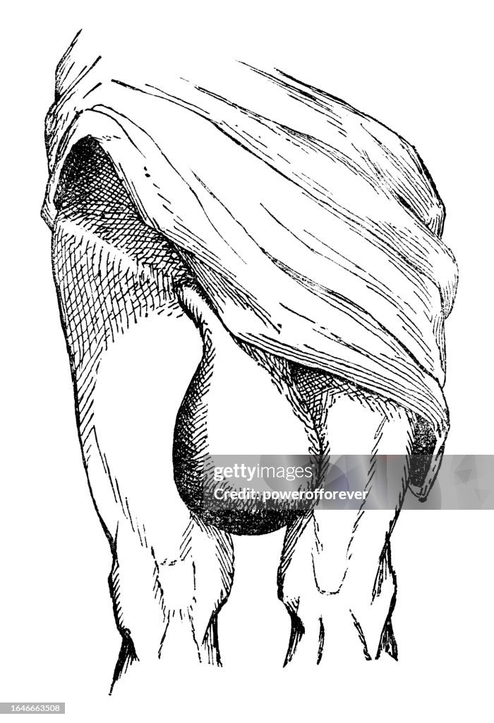 Medical Illustration of a Person with a Complete/Scrotal Hernia - 19th Century