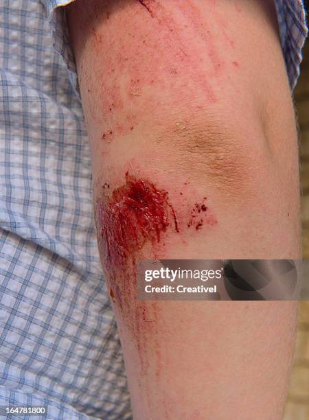 verletzte verschrottet tränendes ellenbogen - wunde stock-fotos und bilder