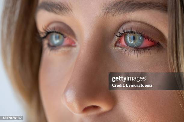 rote augen mit allergie - lederhaut stock-fotos und bilder