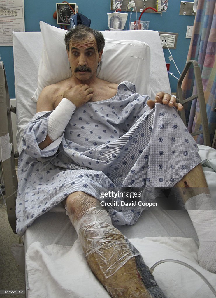 May 24 2010- Bear attack victim Gerald Marois, 47, of Waubaushene, describes to the Star about the t