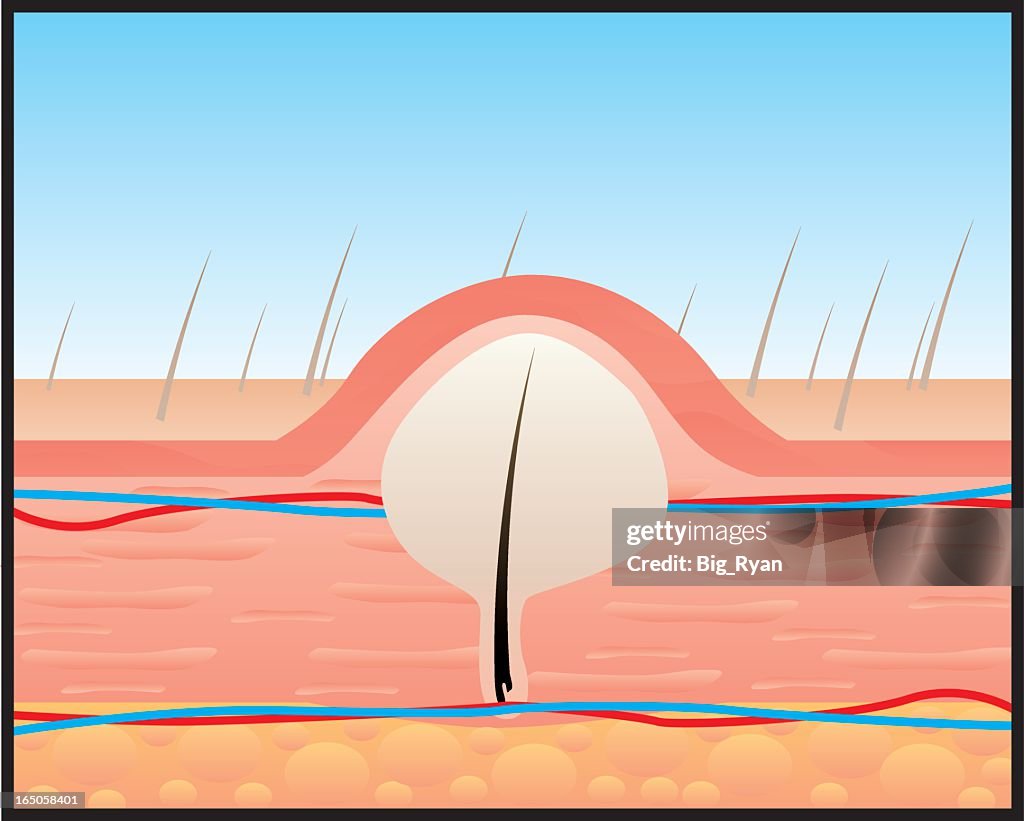 Zit Object Zit Illustration - Getty Images