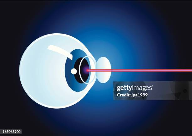 ilustrações, clipart, desenhos animados e ícones de olhos cirurgia a laser - retinopatia diabética