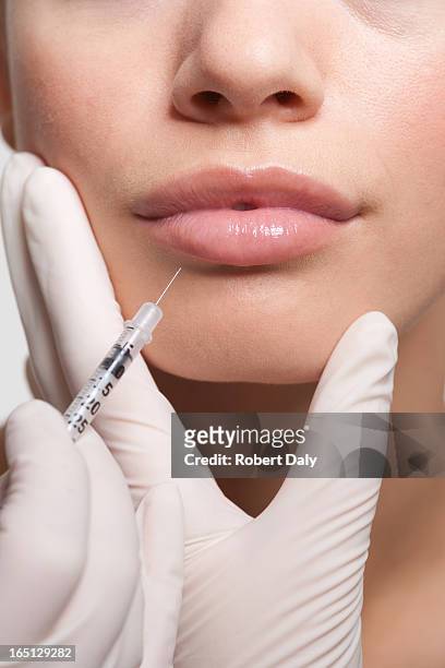 close up of woman receiving botox injection in lips - lip injections stockfoto's en -beelden