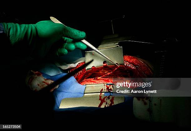 Blood squirts from a severed artery inside the chest of Ashok Verma during his triple bypass surgery, Tuesday morning, February 12, 2008 at St....