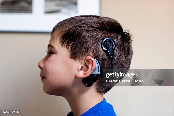 October 18, 2009 --Cochlear Implants-- James and his wife Jule are parents of two deaf children, Marc, 5 and Jenna who hear with Cochlear implants....