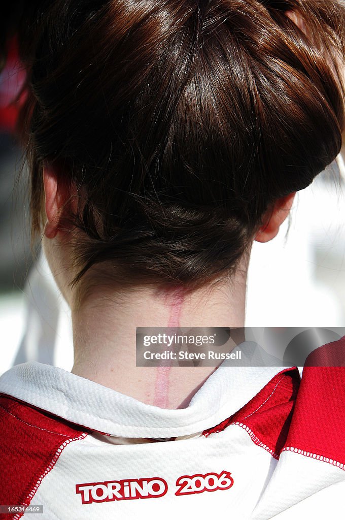 STAROLY-FREESTYLE PRESSER---02/09/06---Deidra Dionne still has the scars from he neck injury in Augu