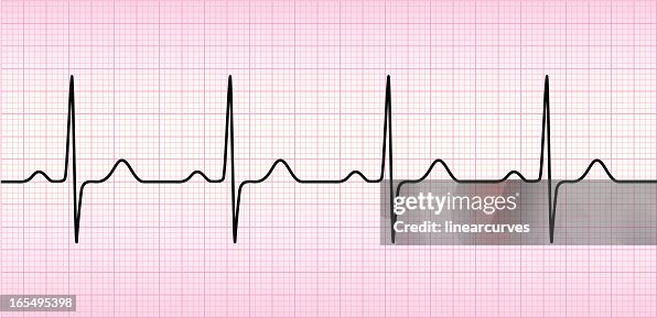 ECG wave ECG wave
