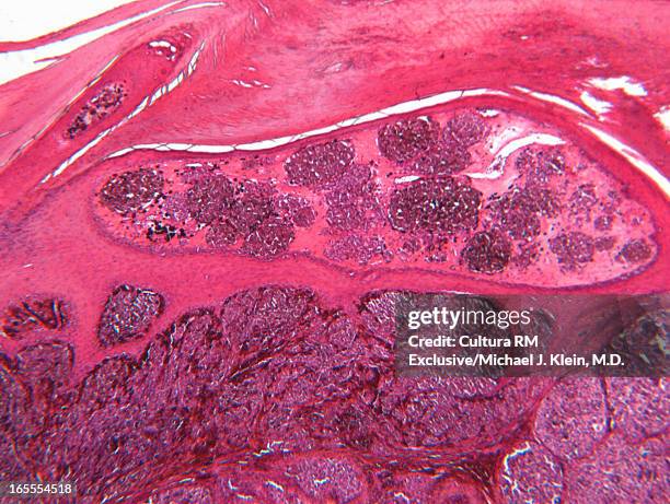 microscope view of malignant melanoma - melanoma stock pictures, royalty-free photos & images