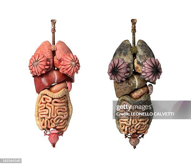 healthy and diseased organs, artwork - cirrhosis 幅插畫檔、美工圖案、卡通及圖標