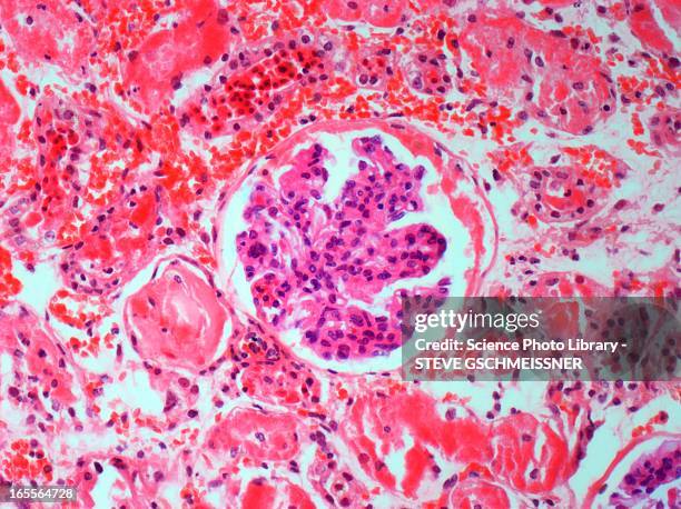 kidney disease, light micrograph - tubule stock pictures, royalty-free photos & images