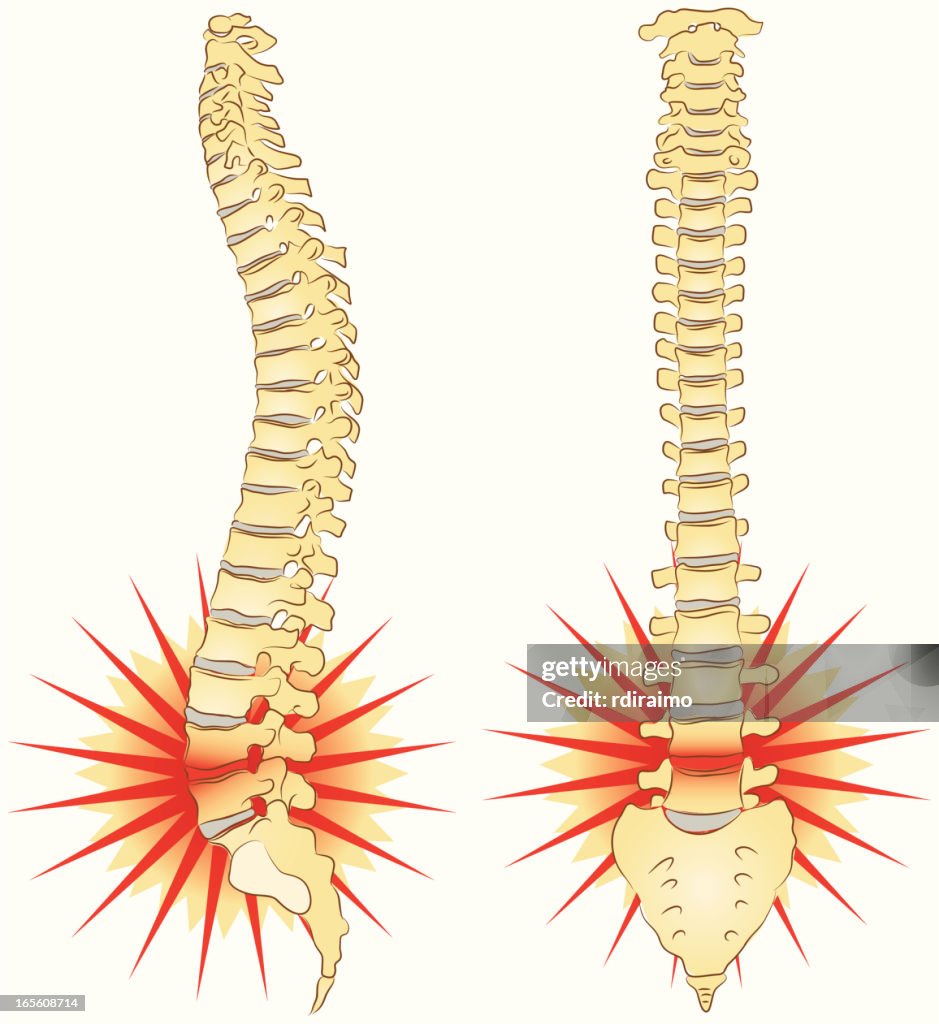 Back Pain