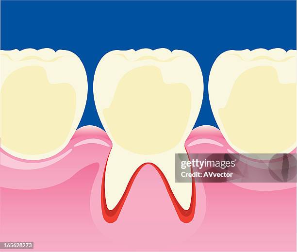 zahn verfall - entzündung stock-grafiken, -clipart, -cartoons und -symbole