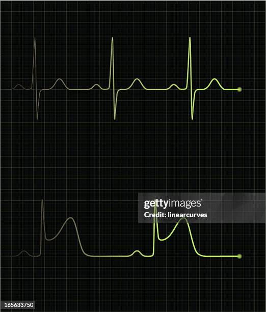 Two Normal Ecg Normal Ecg Photos and Premium High Res Pictures - Getty Images