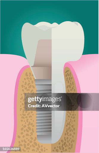 Implant system Implant system