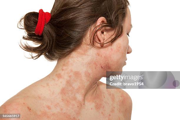 a woman with a skin disorder of atopic dermatitis - dermatitis stock pictures, royalty-free photos & images