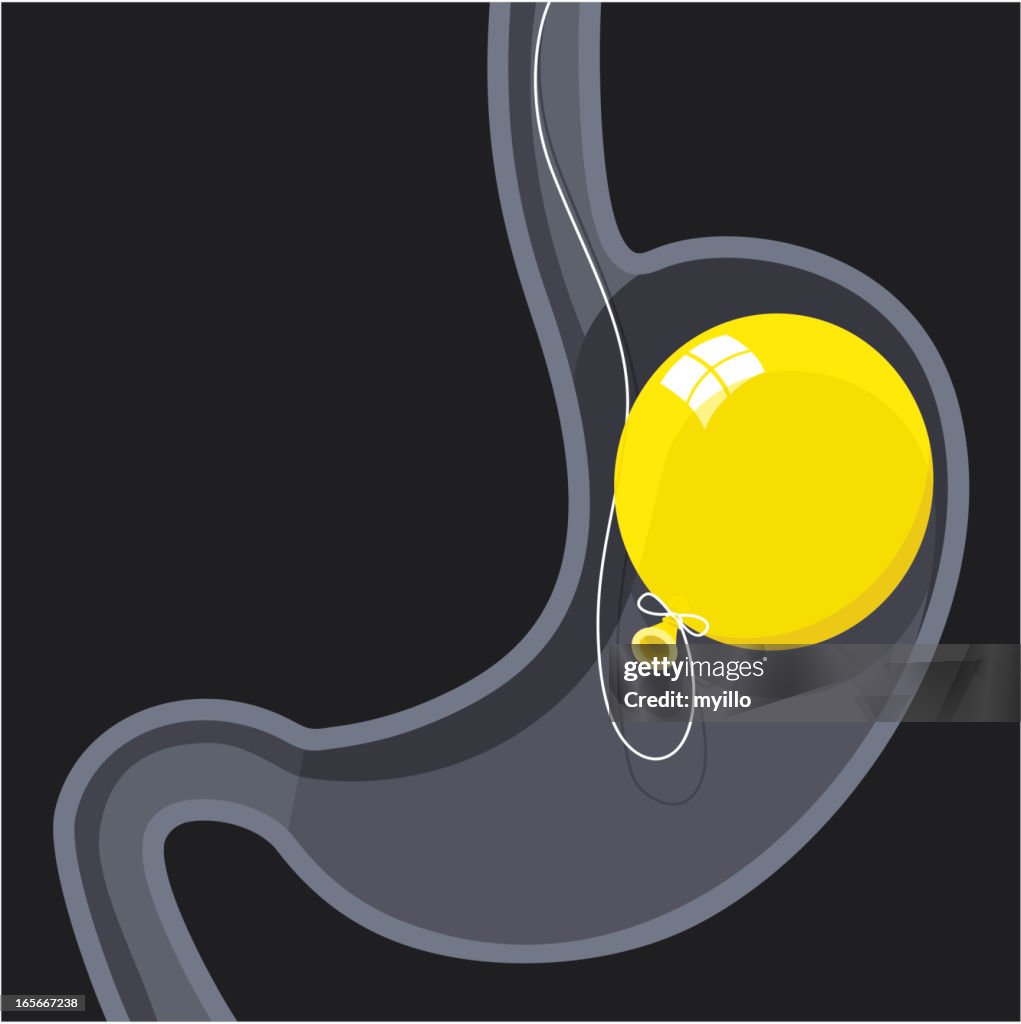 Palloncino in sede intragastrica.