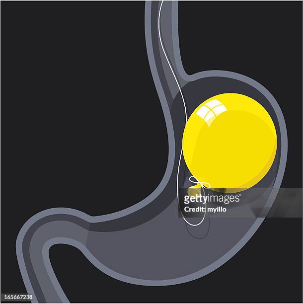 stockillustraties, clipart, cartoons en iconen met intragastric balloon - balloon stomach