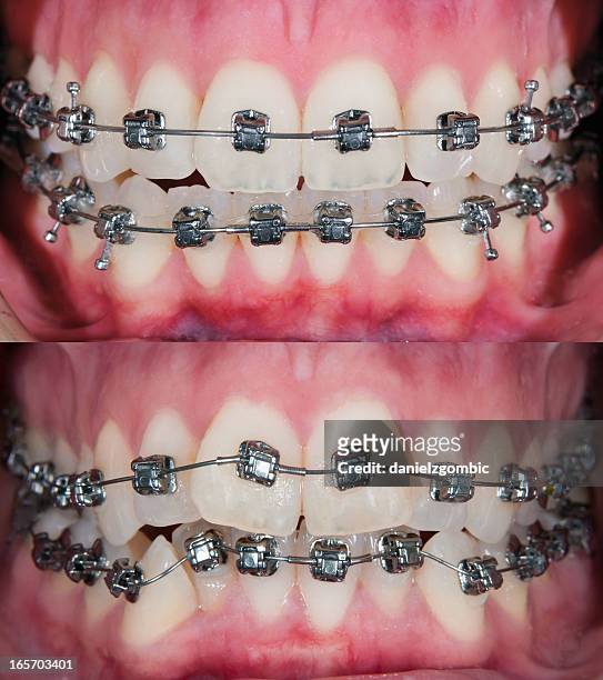 em ortodontia & após o tratamento antes - braces imagens e fotografias de stock