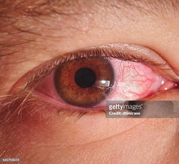 sicke eyeball with pink eye or conjunctivitis - bloodshot 個照片及圖片檔