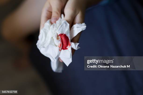 nosebleed ,schoolboy holds tissue with blood - hämophilie stock-fotos und bilder