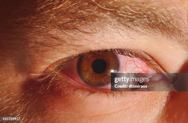 pink eye oder konjunktivitis - red eye stock-fotos und bilder