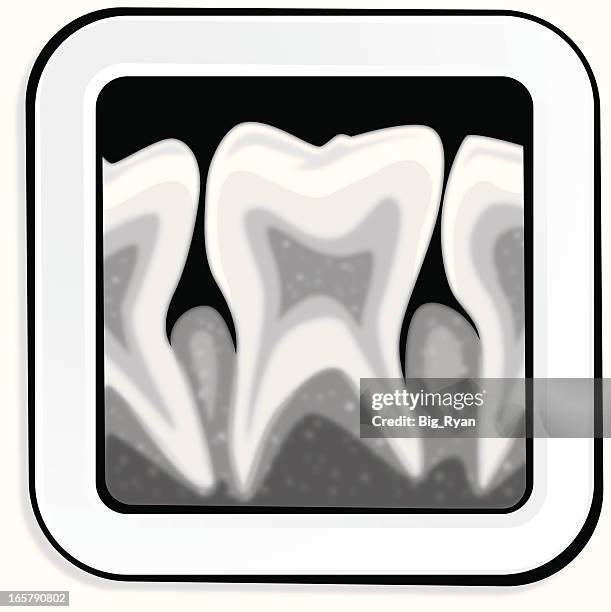 dental xray - periodontal disease stock illustrations