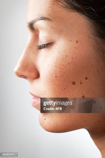 retrato de una mujer con melanoma lunares y de pecas (xxxl - complexion fotografías e imágenes de stock