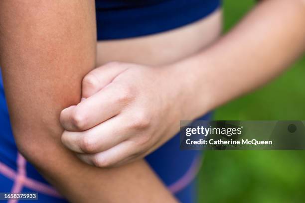young multiracial woman scratches arm after insect bite - spotted fever stock pictures, royalty-free photos & images