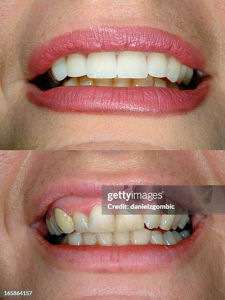 before & after smile design - voor en na stockfoto's en -beelden