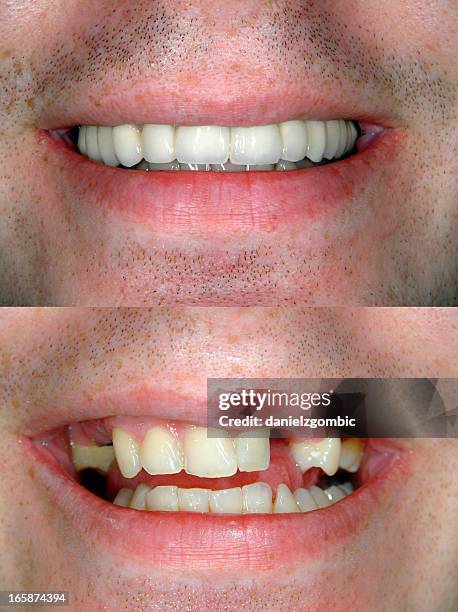before & after smile design - before and after teeth stock pictures, royalty-free photos & images