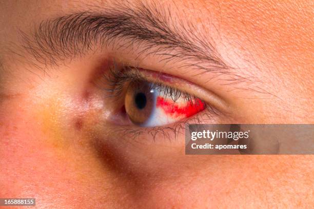 boodshot eye - head wound stock pictures, royalty-free photos & images