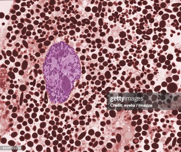 photo taken with an electron microscope of a single malignant white tumor cell - tumore metastatico foto e immagini stock