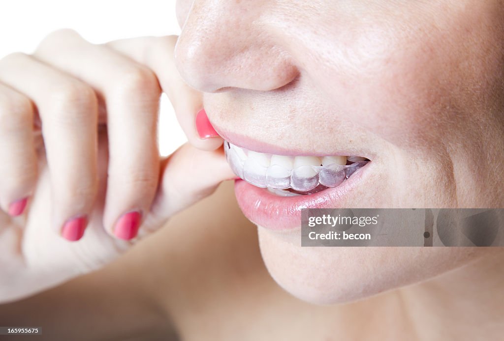 Woman using transparent braces