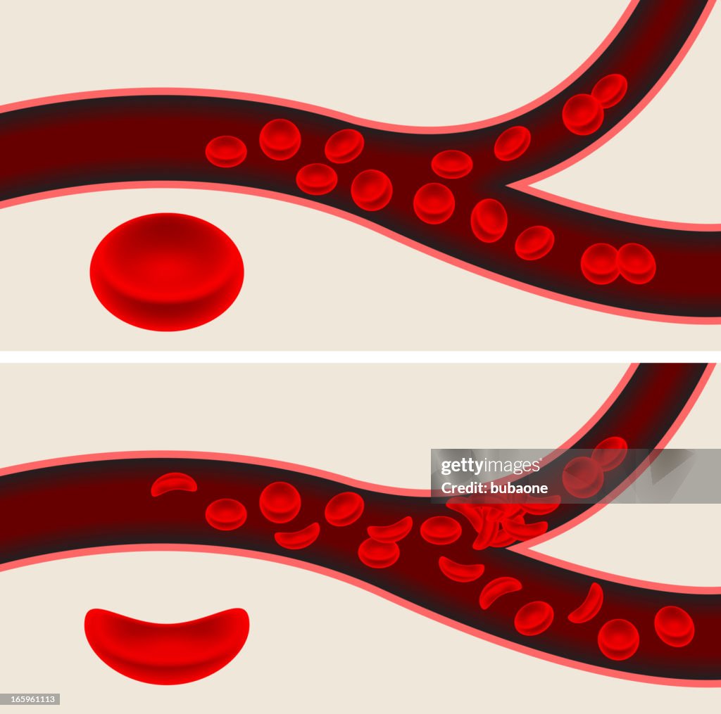 Human blood cells and sickle cell anemia blood flow veins