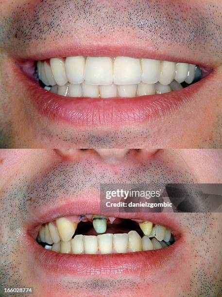 before & after smile design - before and after teeth stock pictures, royalty-free photos & images