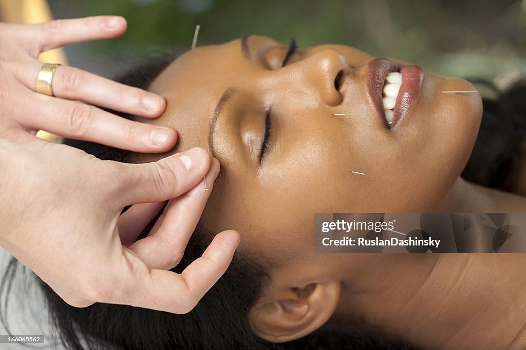 Chinese needle treatment as alternative medicine.