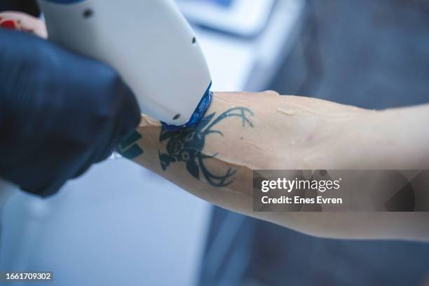 tattoo removal - remover stock pictures, royalty-free photos & images