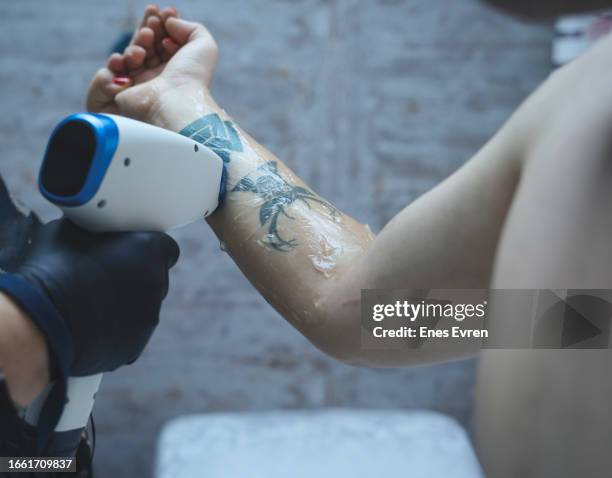 tattoo removal - laser stockfoto's en -beelden